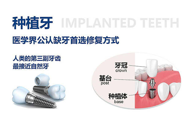 牙齿拔掉多久种牙最好