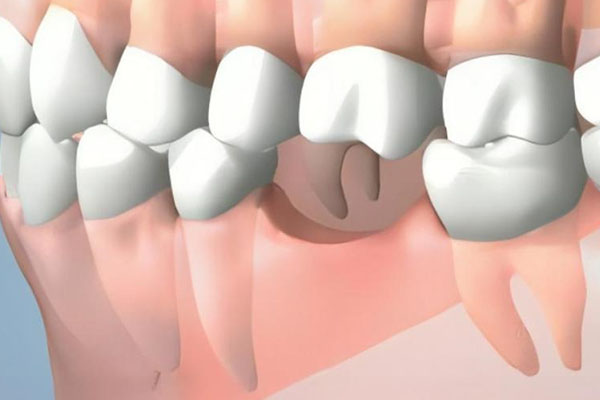 乳牙脱落没有根怎么办？中老年口腔