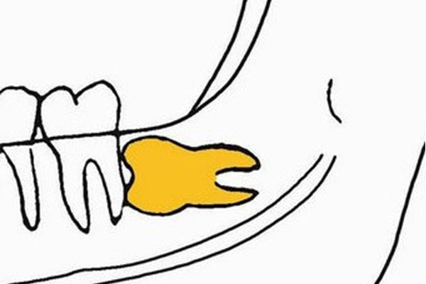 智齿并非人人都有，你的口腔健康可