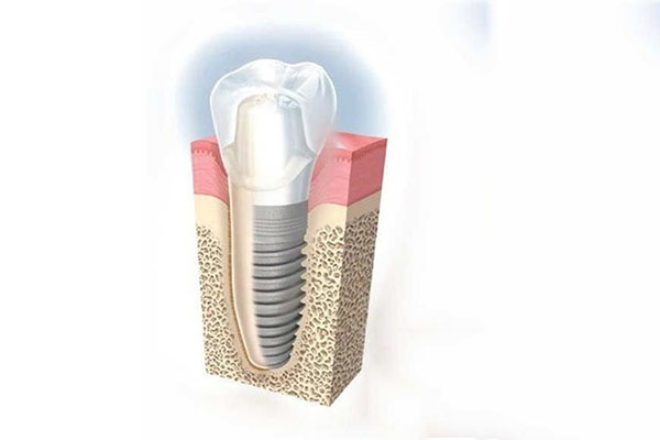 牙掉了怎么办？中老年口腔种牙技术助您轻松解决牙齿缺失问题