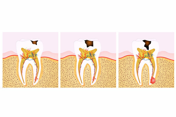 牙齿上面有一点黑的是不是就是蛀牙