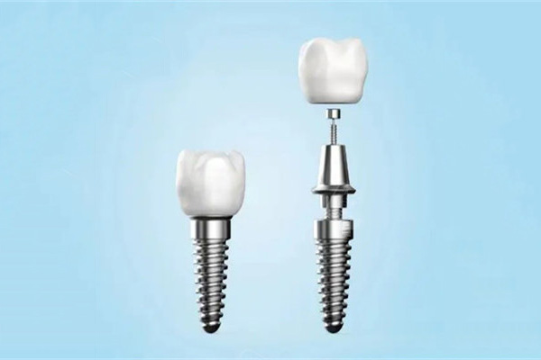 天津种牙价格表出炉 中老年口腔批量种牙更划算