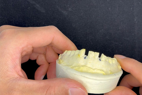 活动假牙吸盘安装新突破！中老年口腔批量解决方案让咀嚼更轻