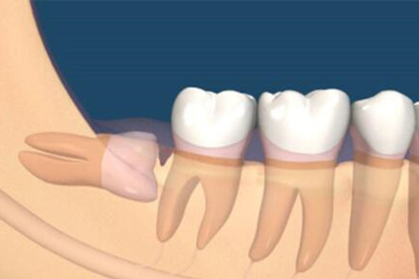 别担心！智齿咬腮帮子不会癌变，中