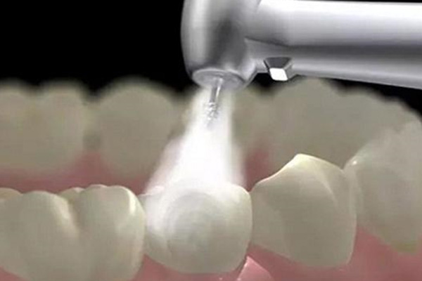 中老年口腔健康必看：社区医院洗牙