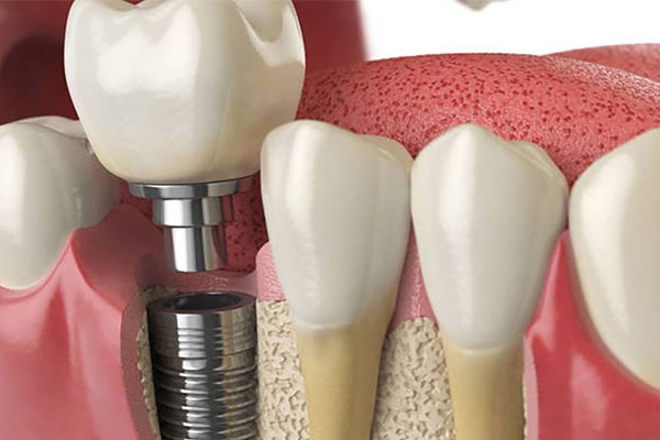 种牙烤瓷牙和全瓷牙哪个更适合中老年人？一文看懂选择不踩坑