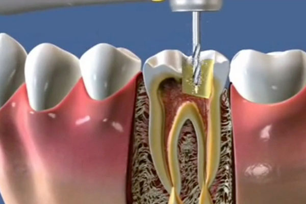 中老年口腔：如何预防和治疗龋牙，守护您的牙齿健康？