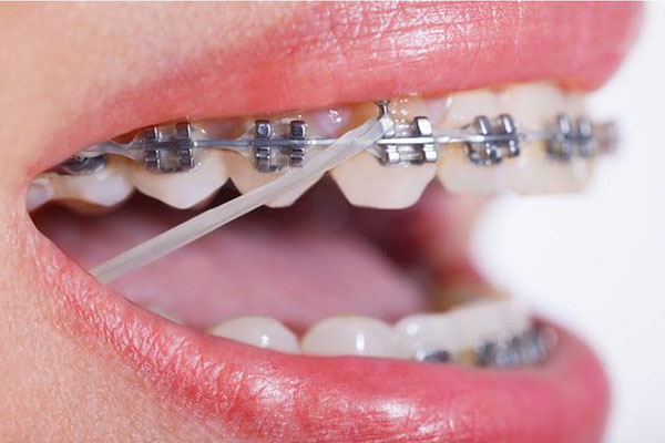 南京牙齿矫正费用全解析——中老年口腔批量修复省心又省钱