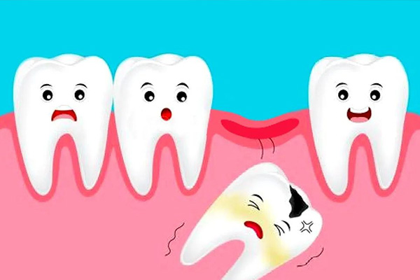 牙齿自然脱落后多久可以进行种植？中老年口腔专家为您解答