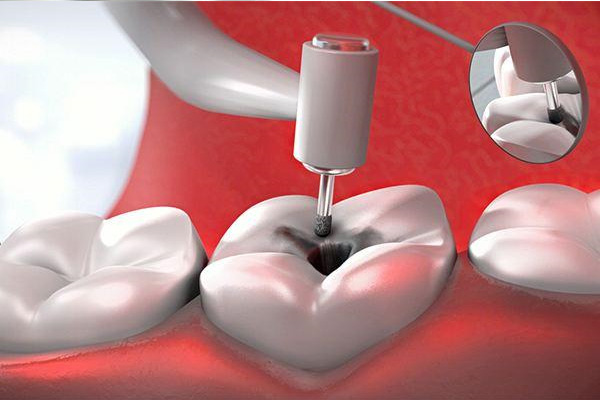 牙齿蛀只剩牙根别急着拔！中老年口腔批量修复技术让缺牙重生
