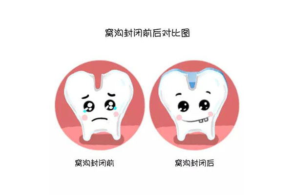 洗完牙涂氟到底有没有用？中老年口腔告诉你答案！