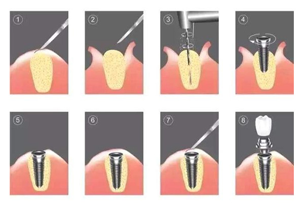 最里边牙齿拔了要种牙吗 选对方法让咀嚼更轻松