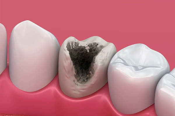 蛀牙坏了一个洞引起的牙龈痛怎么办？中老年口腔给您专业建议