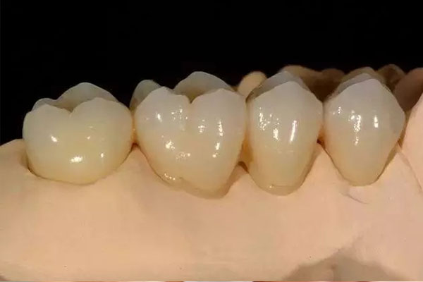 中老年缺牙可以做全瓷牙吗？费用多少？