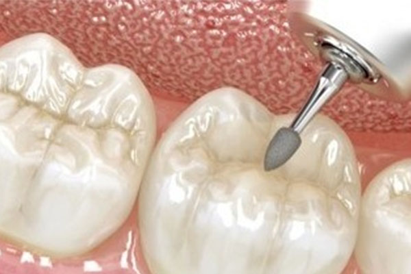 口腔涂氟的副作用和危害有哪些？中老年口腔安全指南