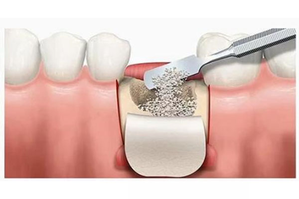 中老年缺牙患者必看：补牙和牙冠怎么选？一文帮你快速做出决