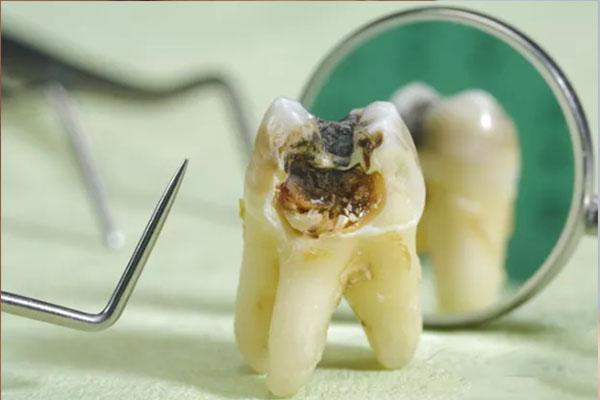 拔智齿为什么贵？中老年口腔告诉你真相，高效解决缺牙难题