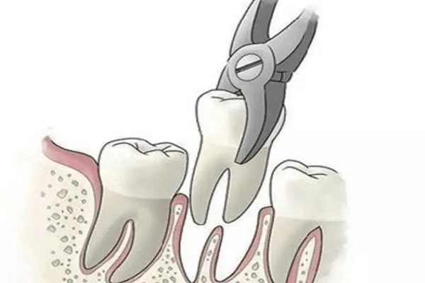 拔牙后别再傻傻等3个月！中老年口腔批量修复技术帮你7天重获