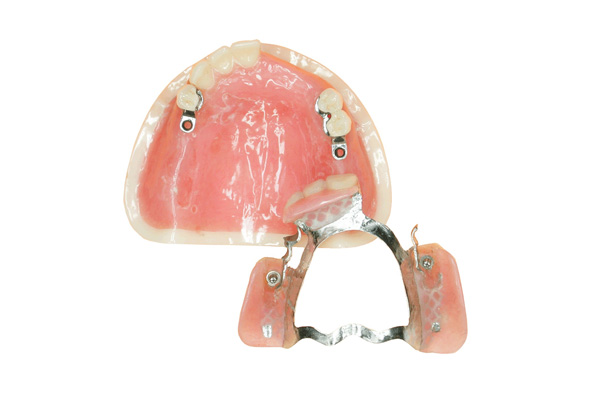 老人装活动假牙的5个关键注意事项，