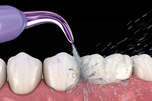 洗牙医保能用吗？中老年口腔批量处