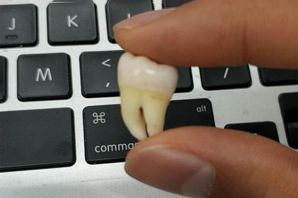 智齿拔除费用揭秘：中老年口腔批量高效解决缺牙烦恼