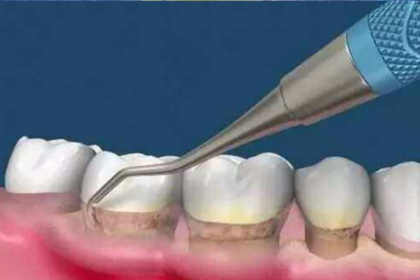 牙结石必须去洗牙吗？中老年口腔为