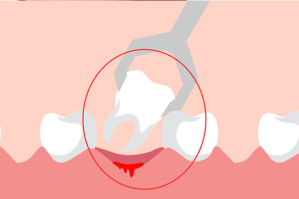 只有两颗智齿需要拔吗？中老年口腔为您解答！