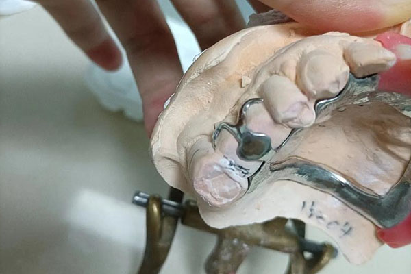 种植义齿的优点：中老年口腔为您解决牙齿缺失烦恼