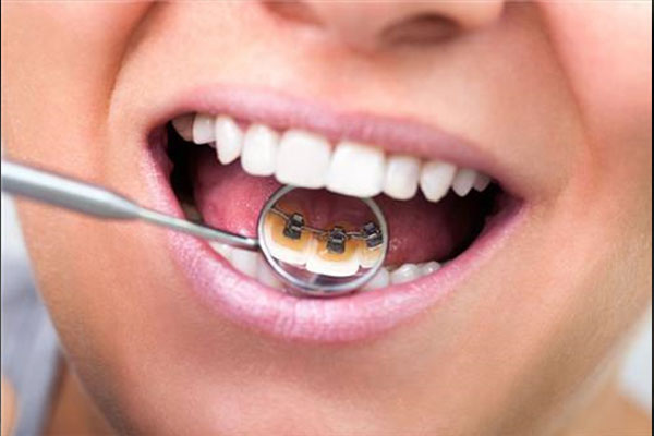 一颗门牙外凸矫正方法，中老年口腔专业为您解决牙齿问题