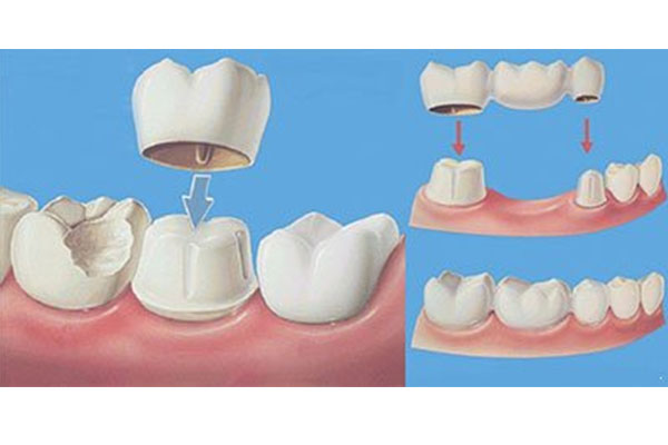补牙必须磨牙吗？中老年口腔创新技