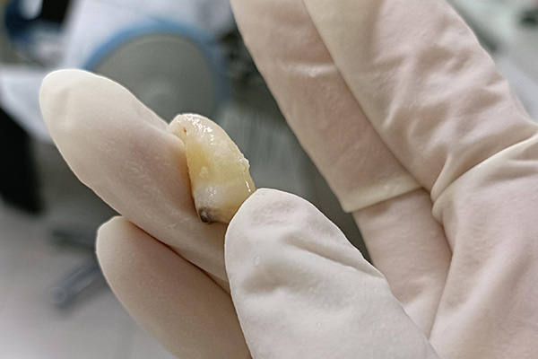 智齿蛀牙别慌！中老年口腔教你高效解决缺牙烦恼