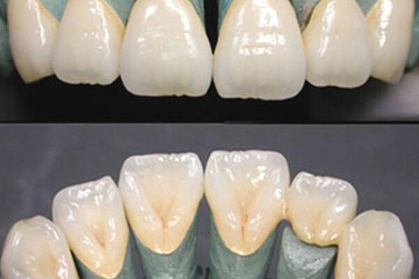 烤瓷牙价格一个多少钱？中老年口腔