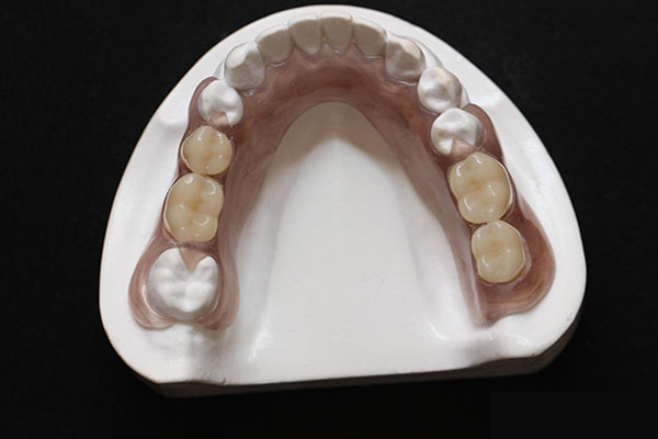 活动假牙隐形好还是带勾好？中老年