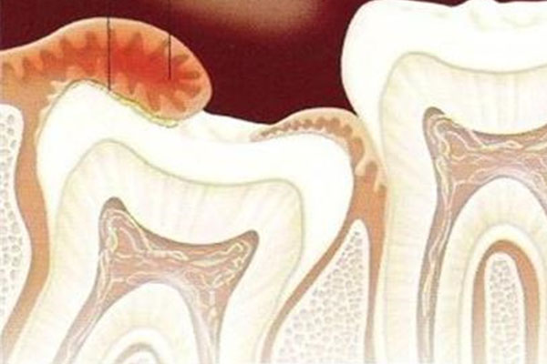 拔智齿多少钱医保能报销？中老年口腔批量种牙更划算