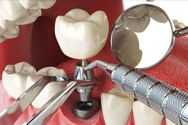 中老年口腔种牙医保能报吗费用多少