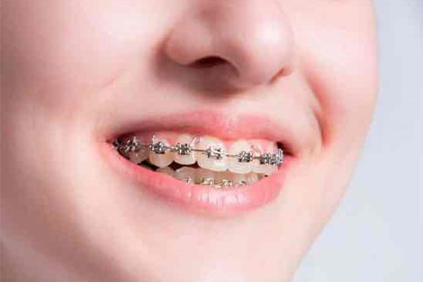 牙齿矫正还有年龄限制？中老年口腔：60岁也能轻松种好牙！