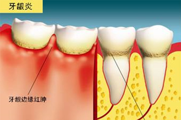 牙髓炎引发三叉神经痛吃什么药见效快？中老年口腔为您解答