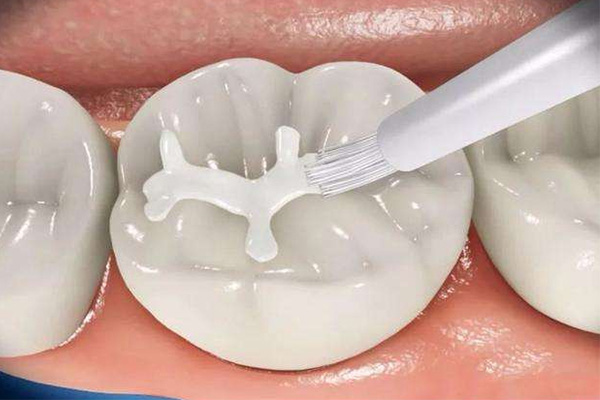 儿童牙齿涂氟的几种方法，中老年口腔专家为您解答！