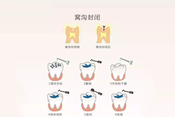 1岁宝宝牙齿涂氟有必要吗？中老年口