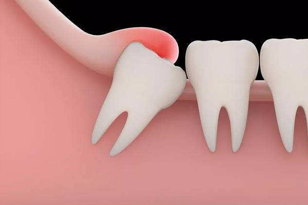 智齿终生不长怎么办？中老年口腔为