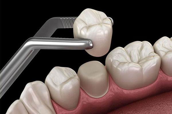 拔牙后看到牙根长肉芽别慌 这样处理更安心