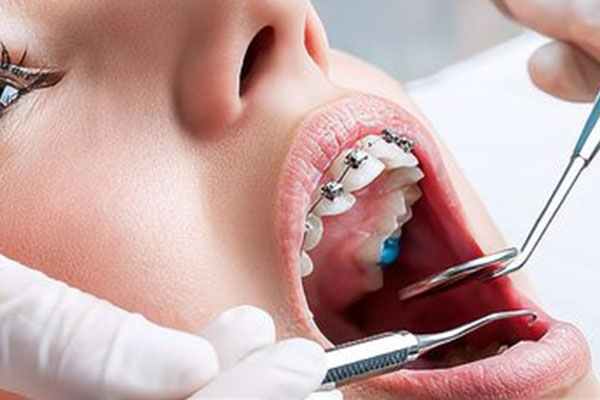 隐形正畸费用太高？中老年口腔批量种牙高效省心