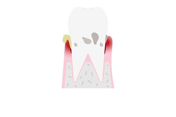 牙髓炎患者的福音：这些涂抹药物轻松缓解疼痛