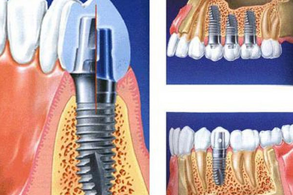 种牙的步骤和时间