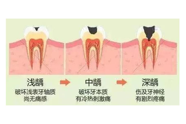 小孩六龄齿蛀牙必须要补吗？中老年