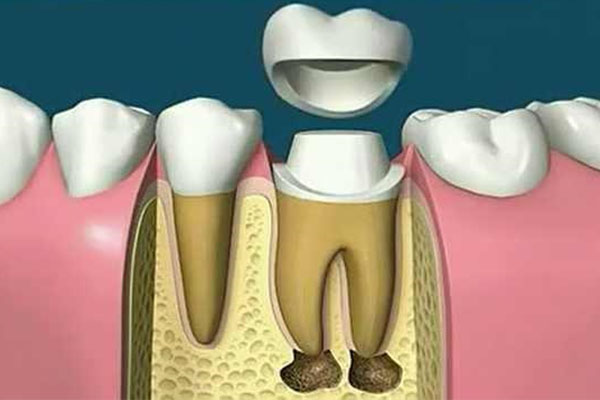 什么补牙齿最结实？中老年口腔为您