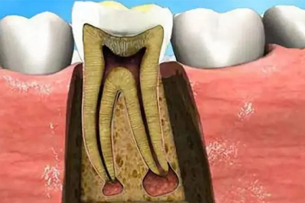 牙周炎引发牙髓炎？中老年口腔专家