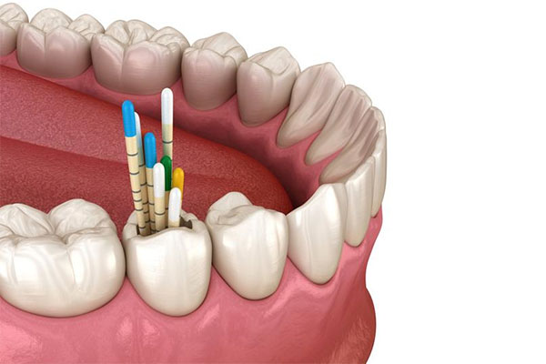补牙洞后牙齿保护有妙招 这样做让中