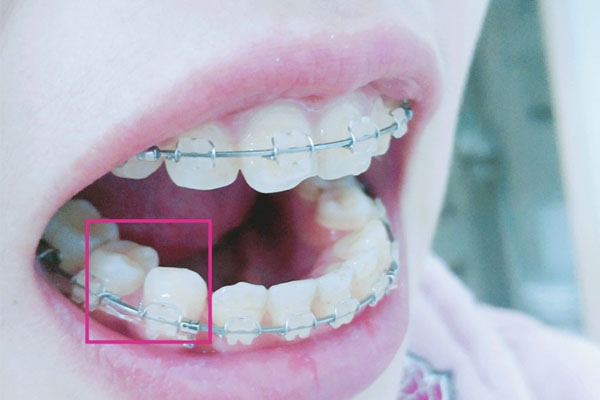 南京矫正牙齿价格表及价格，适合中老年性价比高！