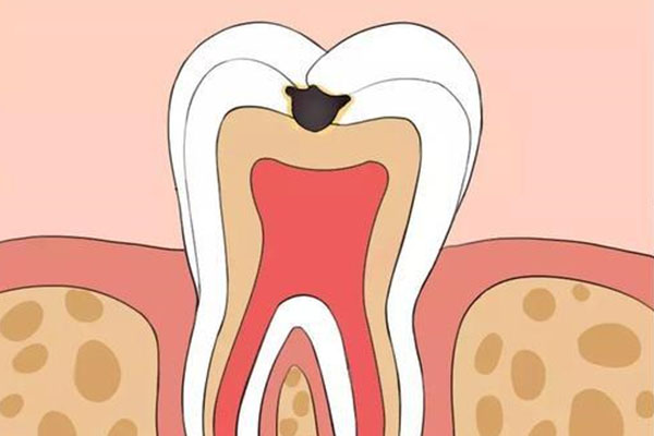 中老年人如何有效预防和消除蛀牙？